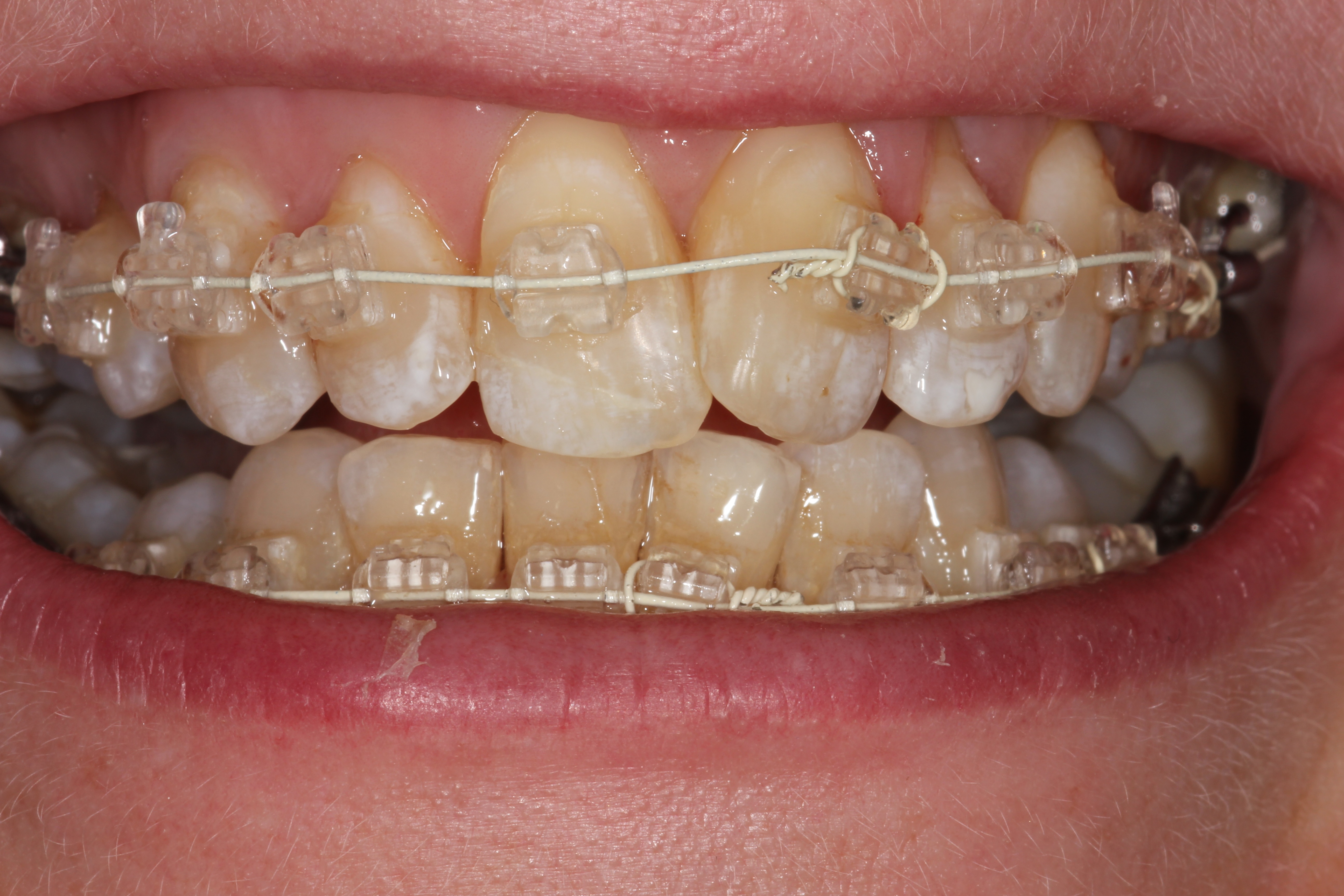 sore teeth braces tightening